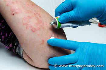 Psoriasis Cream Succeeds in Early Trial