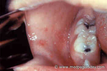 COVID-19 May Manifest in the Mouth in Some Patients