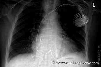 S-ICD Lead Extraction: Early Results Promising in Experienced Hands