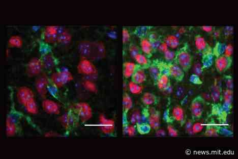 Neural vulnerability in Huntington’s disease tied to release of mitochondrial RNA