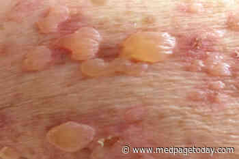 DPP-4 Inhibitors Tied to Blistering Skin Condition