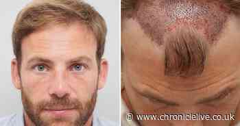 Former Falcons star's dramatic transformation as he shows off hair transplant