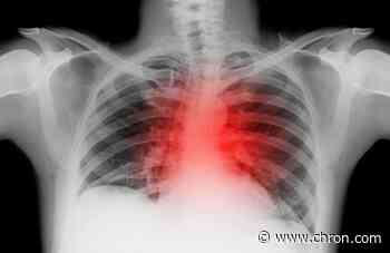 Lasting heart damage could be COVID-19's legacy for some non-hospitalized survivors