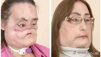 Connie Culp wurde 57: Erste Frau mit Gesichtstransplantation tot