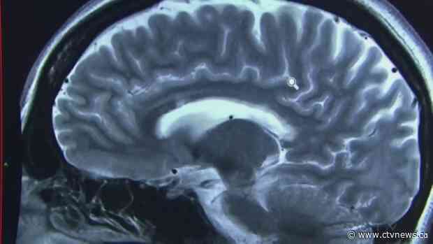 Twelve risk factors responsible for 40 per cent of dementia cases: new research