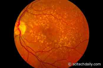 Ancient Part of Immune System May Underpin Severe COVID-19 – Key May Be in Your Eyes