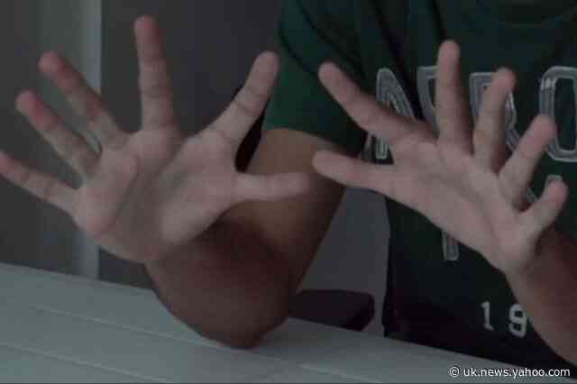What's it like to live with six fingers?