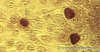 Syphilis outbreaks fuel 5% increase in STDs in Minnesota