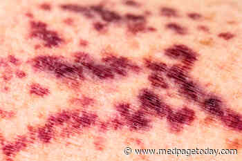 Skin Rashes a Clue to COVID-19 Vascular Disease