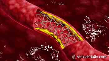 COVID-19 Can Lead to Obstruction of the Blood Vessels in the Lung, Heart and Kidneys