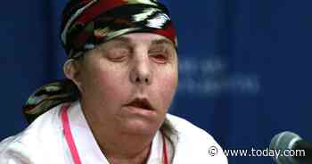 ‘I’m elated’: New Hampshire woman is first to receive a second face transplant