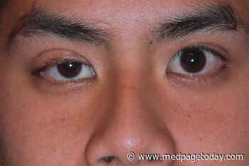 First COVID-19, Then Myasthenia Gravis: Coincidence or Causal?
