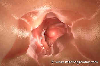 Study ID's Possible Crohn's Disease Prodrome