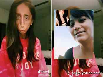 A motivational speaker with a rare genetic condition is condemning a 'hurtful' TikTok trend that she says promotes intolerance among children