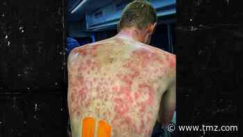 Pro Cyclist Tim Declercq Reveals Gnarly Back Welts After Riding Through Hail Storm