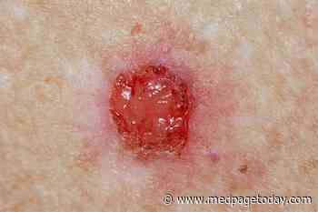 Demographics Make a Difference in Common Skin Cancers