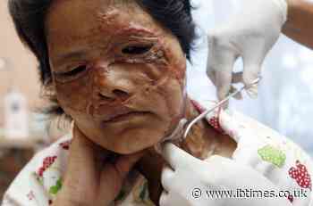 Man throws acid and chops off partner's hand after break up