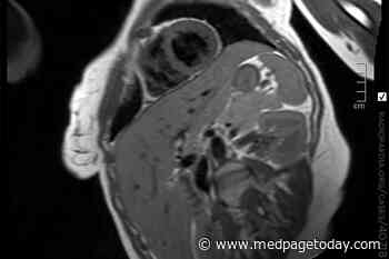 Post-COVID Heart Scans Without Symptoms: Not a Good Idea
