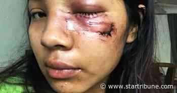 College student sues city of Minneapolis over eye injury from projectile during Floyd protests
