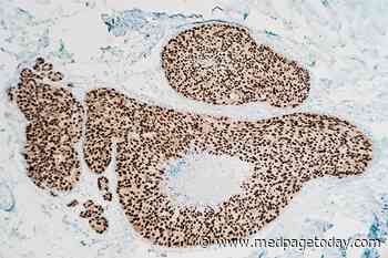 DCIS Tied to Higher Chance of Breast Cancer Death