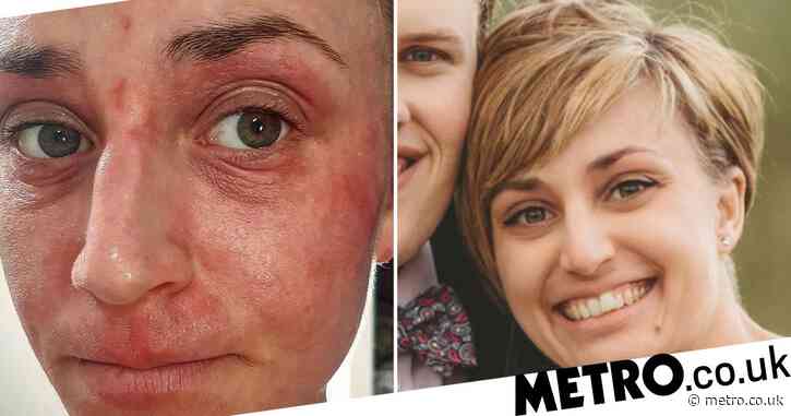 Woman whose angry eczema itching was so bad she needed sleeping pills swears by £8 cream