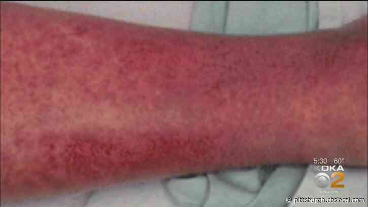 University Of Pittsburgh School Of Medicine Researcher Discovers How Coronavirus Causes Harmful Inflammation