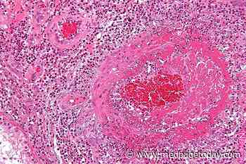 Biologics Beneficial in Eosinophilic Vasculitis