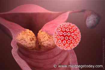 Balstilimab, Zalifrelimab Active in Advanced Cervical Cancer