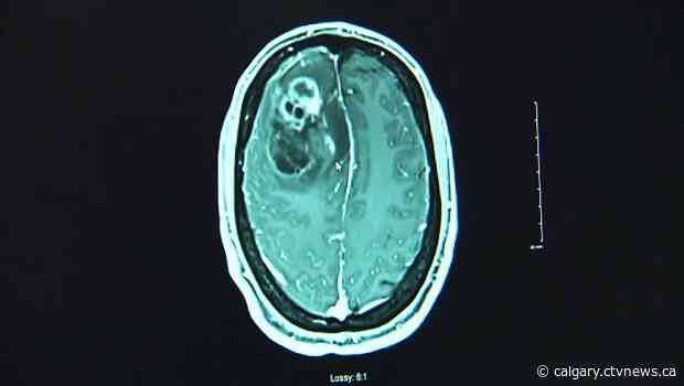 U of C scientists experience 'glimmer of hope' in treatment of brain cancer