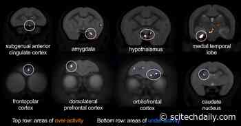 Single Brain Region Links Depression, Anxiety and Heart Disease