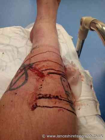Rawtenstall man says he'll 'never get on a bus again' after Burnley bus crash nightmare