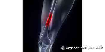 IlluminOss Medical Receives FDA Clearance for Use in Femur and Tibia Fractures as a Supplement to Approved Hardware - OrthoSpineNews
