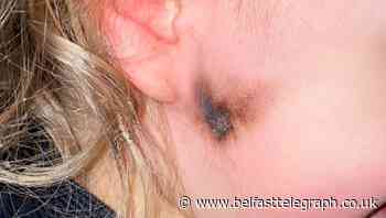 Northern Ireland toddler could have been blinded by firework thrown into garden