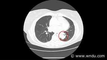 Medical Moment: Breakthrough treatment for lung cancer - WNDU
