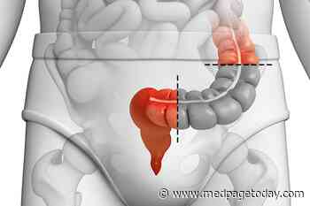Elective Sigmoidectomy Boosts QOL in Recurrent Diverticulitis