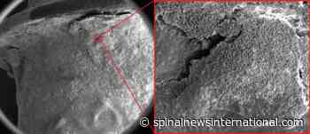 New study first to visually capture biofilm architecture in retrieved implants from live patients - Spinal News International