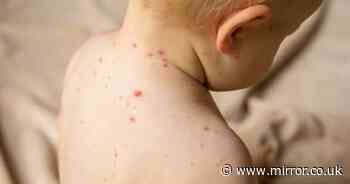 Measles cases surge as Covid-19 means fewer children vaccinated during lockdown