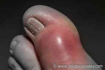Lifestyle Mods May Head Off Gout