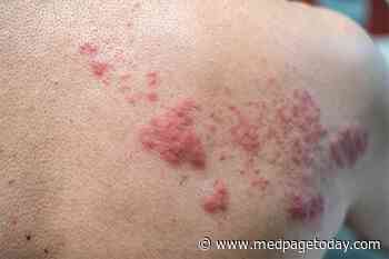 Shingles Recurrence or Something Worse?