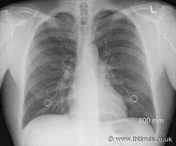 COVID-19 may cause severe lung damage leading to lung transplant