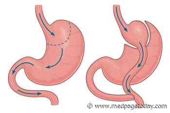 Gastric Bypass Tops Banding for T2D Remission