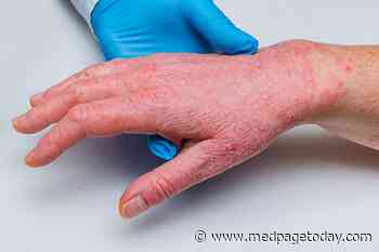 Clinical Challenges: Treatment of Psoriatic Arthritis