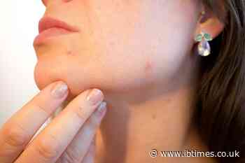 Hydrocolloid bandages: Simple acne hack that is taking TikTok by storm