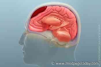 Trial Questions Dexamethasone in Chronic Subdural Hematoma