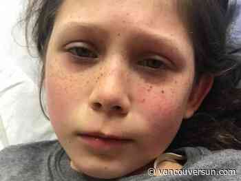 MIS-C: 10-year-old B.C. girl hospitalized with rare COVID-19 syndrome