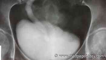 What Is the Cause of This Solid White Lesion in a Ureterocele?