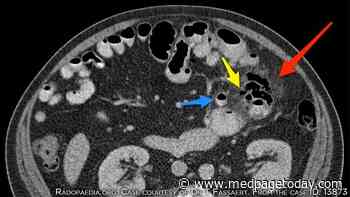 Laparoscopic Lavage a Safe Option in Perforated Diverticulitis