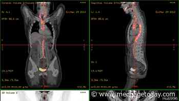 PET Scans Reveal Vascular Inflammation