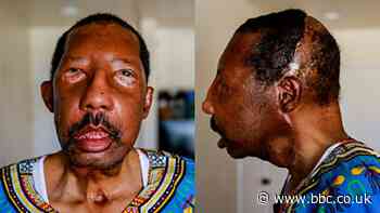 'My new life with a stranger's face'