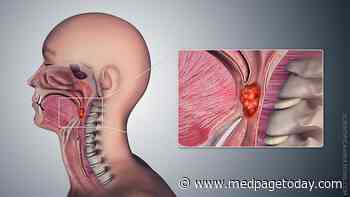 Nuanced View of Oral Sex, HPV+ Oropharyngeal Cancer